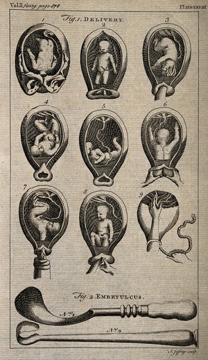 view Nine diagrams of babies in the womb and two illustrations of obstetrical instruments. Etching by T. Jefferys.