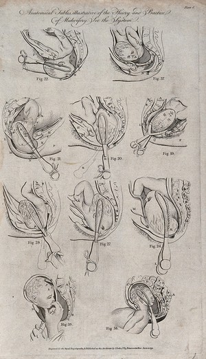 view Ten diagrams illustrating various methods of delivering a baby using forceps. Etching, 1791.