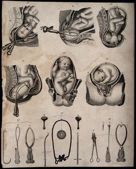 Six diagrams of babies being delivered with the aid of forceps and three illustrations of obstetrical instruments. Engraving.