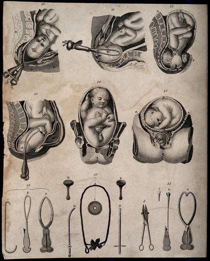 Six diagrams of babies being delivered with the aid of forceps and three illustrations of obstetrical instruments. Engraving.