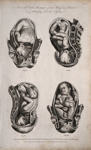 view Four babies in different delivery positions in the womb. Engraving by W. Taylor, 1791, after F. Birnie after W. Smellie.