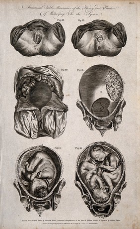 Two diagrams of a childs head starting to emerge from the vagina; two cross-sections of an exposed uterus and two diagrams of a single child and twins in the womb. Engraving by W. Taylor, 1791, after F. Birnie after W. Smellie.