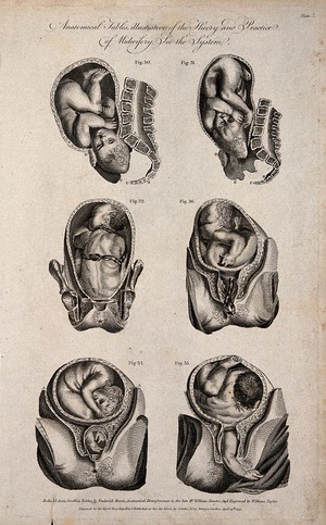 view Six diagrams of babies in different delivery positions in the womb. Engraving by W. Taylor, 1791, after F. Birnie after W. Smellie.