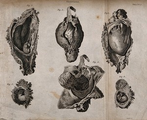 view Six diagrams of abortions at different stages. Engraving by Campbell.