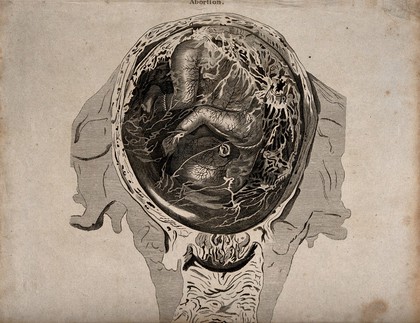 An abnormal foetus in the womb, which is about to be naturally aborted. Engraving.