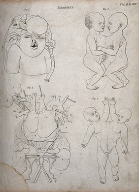 Two diagrams of conjoined twins, a foetus with a deformed head and face and an interior of a chest with two hearts. Line engraving.