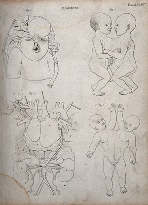 view Two diagrams of conjoined twins, a foetus with a deformed head and face and an interior of a chest with two hearts. Line engraving.