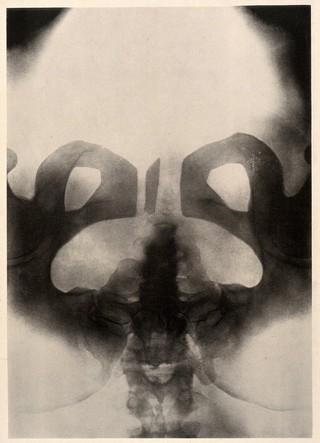 A woman's pelvis after a pubiotomy - to widen the birth canal for a vaginal delivery of a baby. Collotype by Römmler & Jonas after a radiograph made for G. Leopold and Th. Leisewitz, 1908.