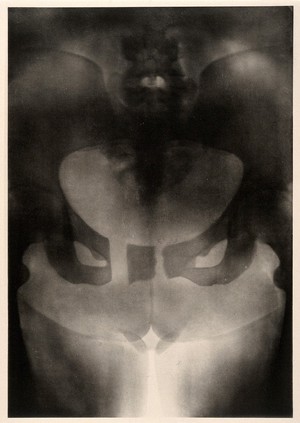 view A woman's pelvis after a pubiotomy - to widen the birth canal for a vaginal delivery of a baby - previous two babies died. Collotype by Römmler & Jonas after a radiograph made for G. Leopold and Th. Leisewitz, 1908.