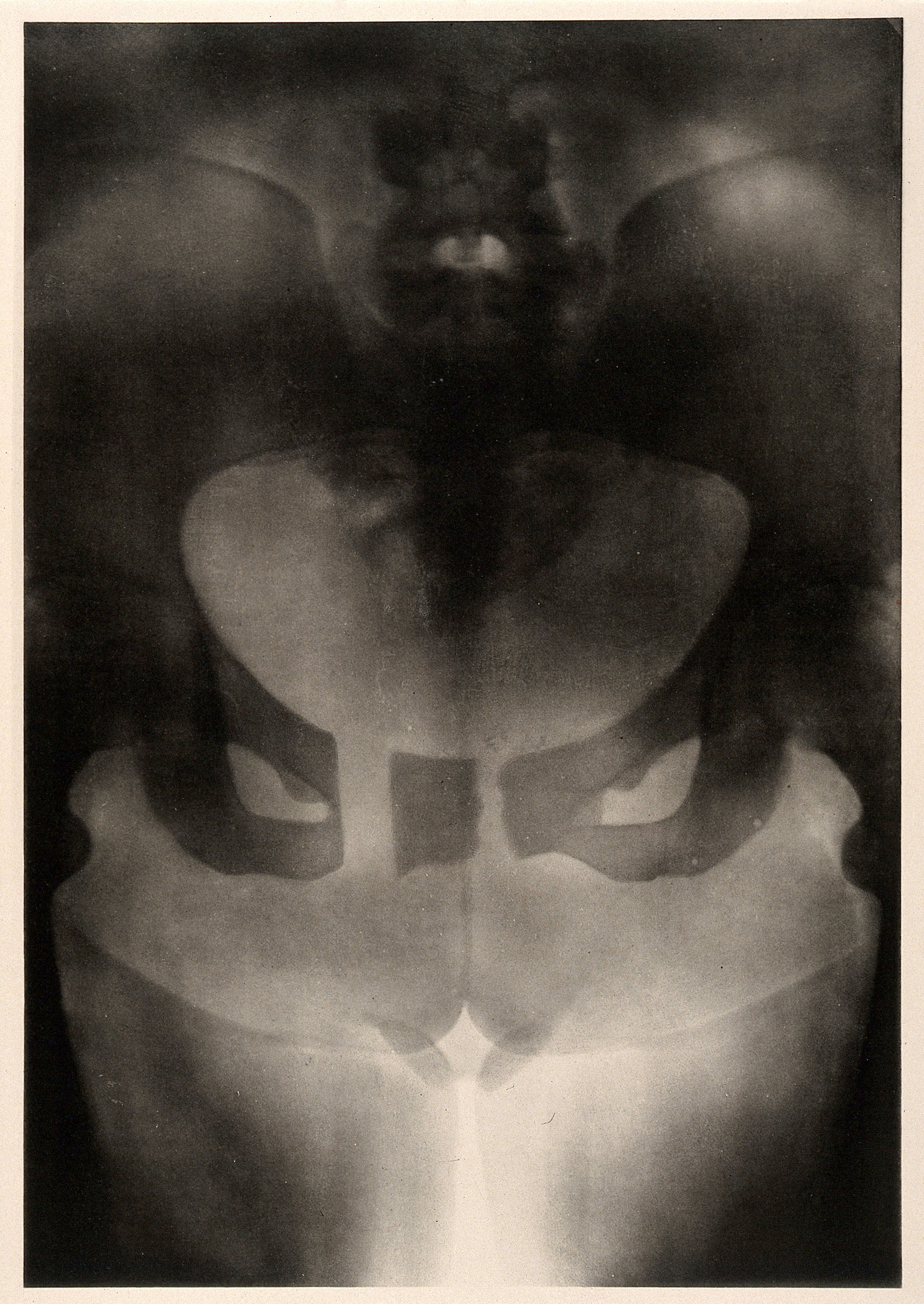 A woman's pelvis after a pubiotomy - to widen the birth canal for a vaginal delivery of a baby - previous two babies died. Collotype by Römmler & Jonas after a radiograph made for G. Leopold and Th. Leisewitz, 1908.
