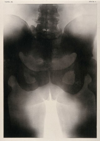 A woman's pelvis after a succesful pubiotomy - a surgical incision of the symphysis pubis generally to widen the birth canal for vaginal delivery. Collotype by Römmler & Jonas after a radiograph made for G. Leopold and Th. Leisewitz, 1908.