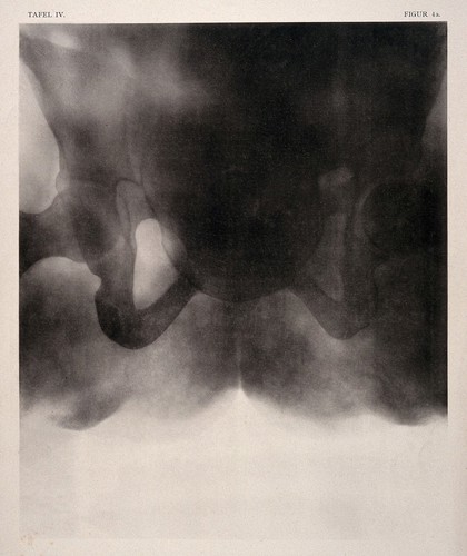 A woman's narrow pelvis with child's head stuck in the middle of labour. Collotype by Römmler & Jonas after a radiograph made for G. Leopold and Th. Leisewitz, 1908.