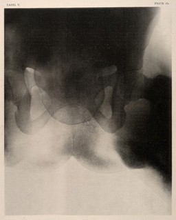 A woman's narrow pelvis with child's head stuck in the middle of a labour. Collotype by Römmler & Jonas after a radiograph made for G. Leopold and Th. Leisewitz, 1908.