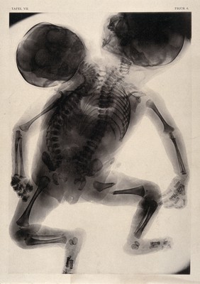 A skeleton of a child born with two backbones and two heads. Collotype by Römmler & Jonas after a radiograph made for G. Leopold and Th. Leisewitz, 1908.