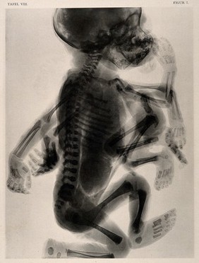 A skeleton of a child with a set of superfluous limbs and deformed head. Collotype by Römmler & Jonas after a radiograph made for G. Leopold and Th. Leisewitz, 1908.