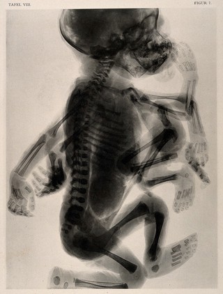 A skeleton of a child with a set of superfluous limbs and deformed head. Collotype by Römmler & Jonas after a radiograph made for G. Leopold and Th. Leisewitz, 1908.