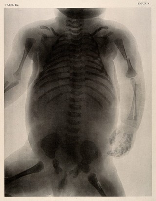 A skeleton of a new born child with deformed hips who died of asphyxia in birth. Collotype by Römmler & Jonas after a radiograph made for G. Leopold and Th. Leisewitz, 1908.