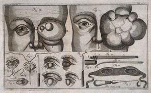 view Eye diseases and surgical instruments. Line engraving by F. Sesone, 1749.