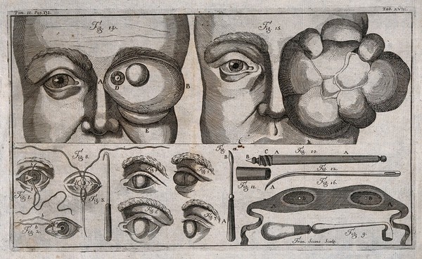 Eye diseases and surgical instruments. Line engraving by F. Sesone, 1749.