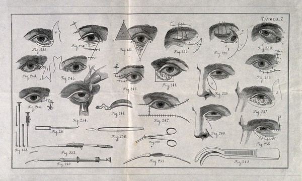 A sheet showing optical instruments, eye examinations, and diagrams of the eye surgery with a numbered key. Wood engraving.
