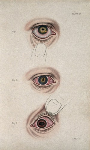 view Inflamed eye defects: three figures. Coloured stipple engraving by H. Adlard.
