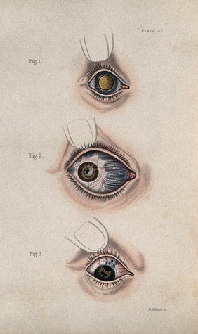 Inflamed bloodshot eye defects: three figures. Coloured stipple engraving by H. Adlard.