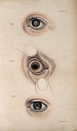 Inflamed bloodshot eye defects: three figures. Coloured stipple engraving by H. Adlard.