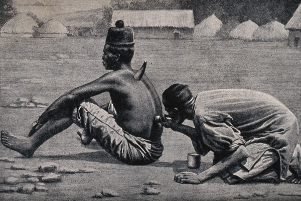 An African medicine man or shaman applying the technique of cupping to a patient (using animal horns), which involves drawing blood to the surface of the body. Halftone.