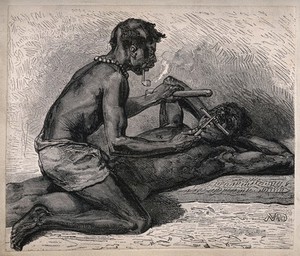 view An African dentist performing an operation on a patient that he is restraining with a wooden stick. Wood engraving by MD.