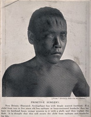 view A boy with deep scars on his forehead as a result of surgery, in an attempt to cure epilepsy and headaches, Bismarck Archipelago (Papua New Guinea). Halftone.