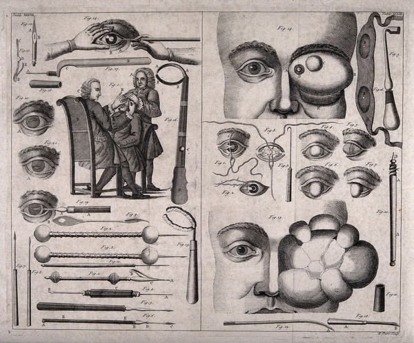 Ophthalmology instruments, eye growths, a cataract operation and other eye defects. Line engraving by R. Parr, 1743-45.