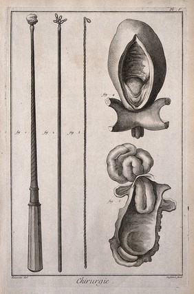 Surgery: Left, surgical instruments to retrieve foreign objects from the oesophagus; right, a bladder with a bladderstone and a hernia. Engraving with etching by Defehrt after L.-J. Goussier.