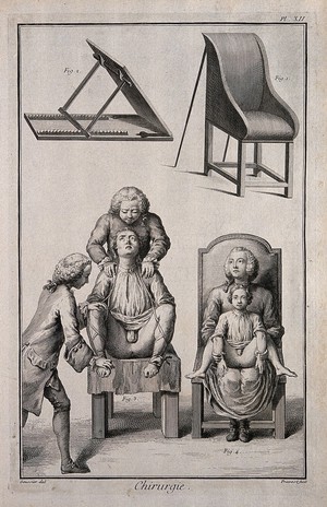 view Surgery: above, a chair-bedstead and a patient-dossier; below, a man and a child seated on the chair-bedstead. Engraving by B.L. Prevost after Louis-Jacques Goussier.