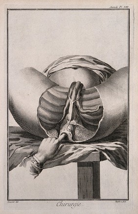 Surgery: the examination of the perineum. Engraving with etching by A.J. Defehrt after L.-J. Goussier.