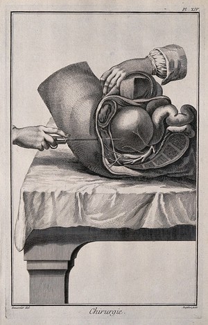 view Surgery: lateral section of the hypogastrum. Engraving with etching by A.J. Defehrt after L.-J. Goussier.