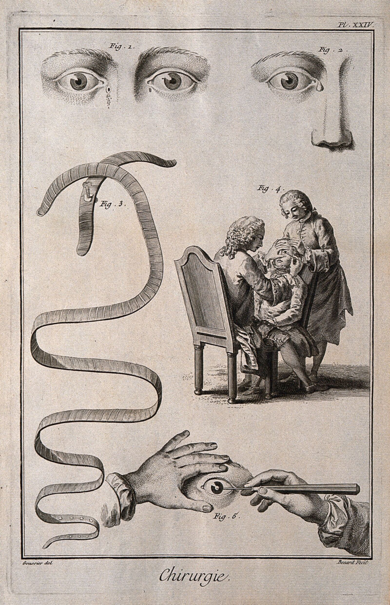 Surgery: instruments for the treatment of cataracts and fistulas of the lacrimal canals. Engraving by R. Benard after Louis-Jacques Goussier., 1700-1799, by Louis-Jacques Goussier