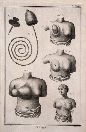 view Surgery, top, instruments to perform a bronchostomy; below, breasts with tumours. Engraving with etching by B.L. Prevost after L.-J. Goussier.