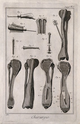 Surgical instruments and cross-sections of diseased bones. Engraving with etching.