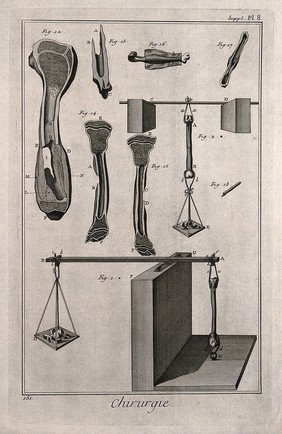 Surgical instruments and cross-sections of diseased bones. Engraving with etching.