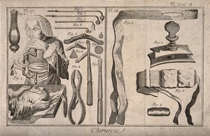 view Surgical instruments and patients undergoing treatment (trepanation). Engraving with etching.