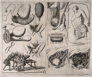 view Surgical instruments and the performance of an operation on the abdomen. Engraving with etching by R. Parr.