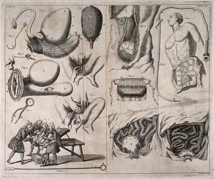 Surgical instruments and the performance of an operation on the abdomen. Engraving with etching by R. Parr.