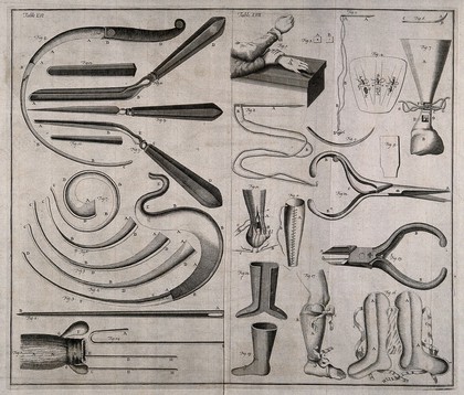 Two kinds of anal fistulas, instruments recommended by Rungius (surgeon in Bremen) to cure anal fistulas and various probes and needles for the treatment Engraving with etching.