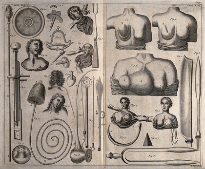 Left, methods of dividing the frenum of the tongue; right, breasts with breast cancer and a rectilinear cicatrix after the cure. Engraving with etching by R. Parr.