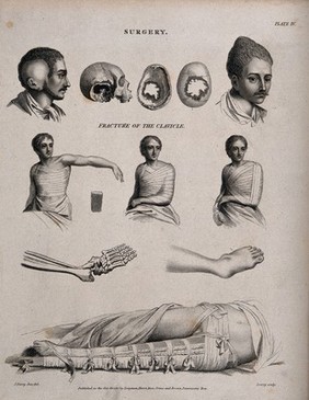 Surgery: patients with fractured clavicles and bandaged clavicles. Engraving by Wilson Lowry after John Farey jun.