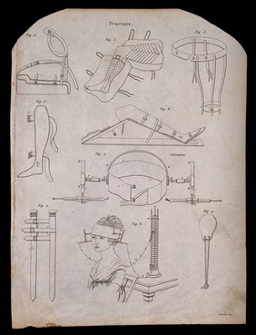 Surgical implements for the treatment of fractures. Engraving by Campbell.