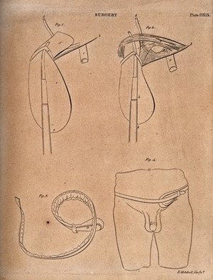 view Surgical instruments for the treatment of hernias. Engraving by E. Mitchell.