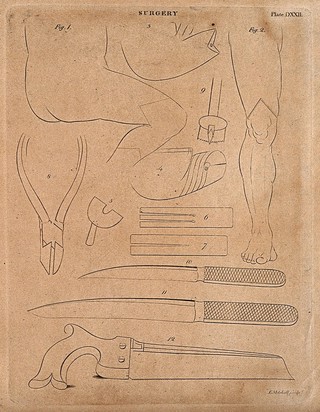 Surgical instruments for the treatment of leg injuries. Engraving by E. Mitchell.