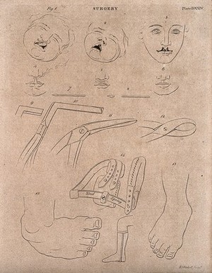 view Surgical instruments to correct cleft lip. Engraving by E. Mitchell.