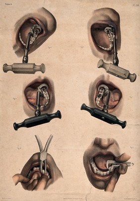 Dental surgical instruments. Coloured lithograph by Lemercier, Bernard after Leveille.